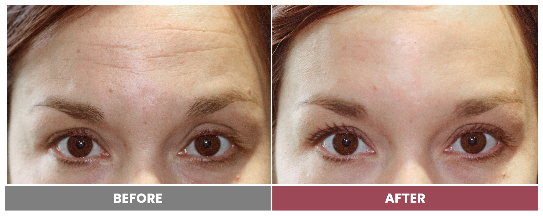 BOTOX FOR WRINKLES & BROW LIFT - Case 7